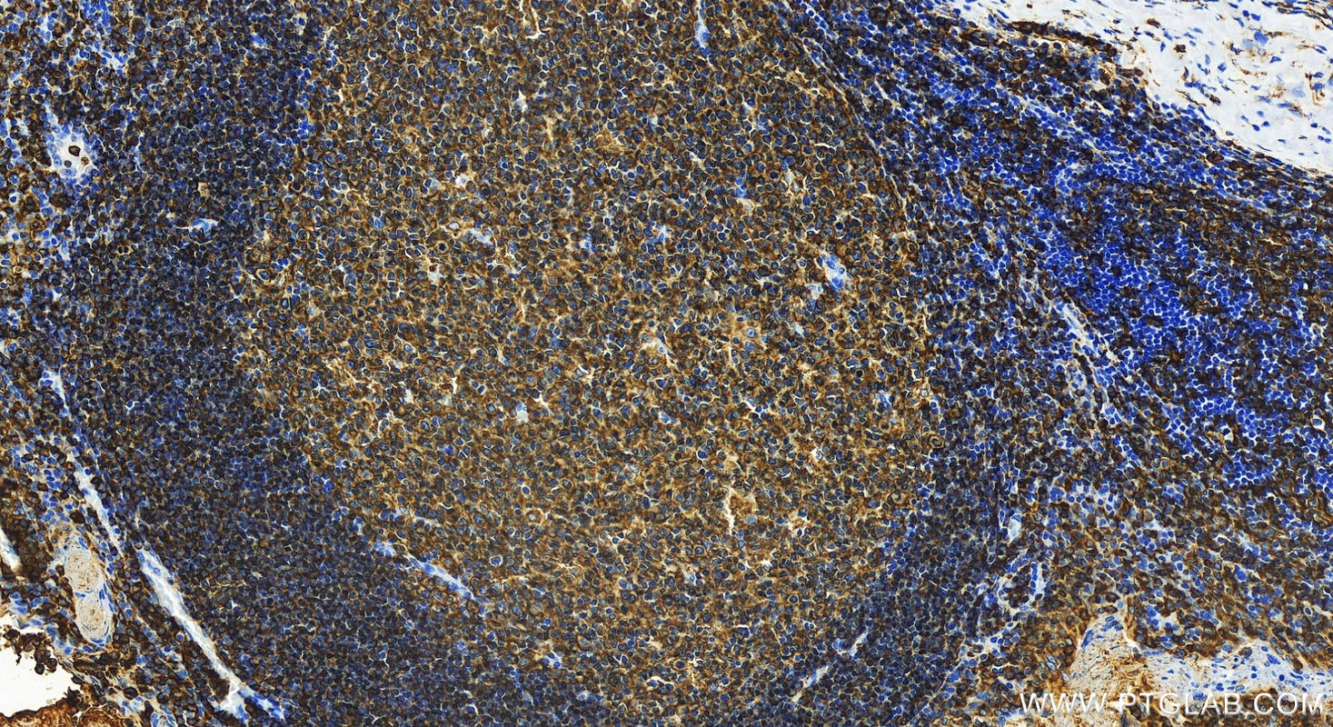 Immunohistochemistry (IHC) staining of human tonsillitis tissue using HLA-DRB4 Recombinant antibody (83103-1-RR)