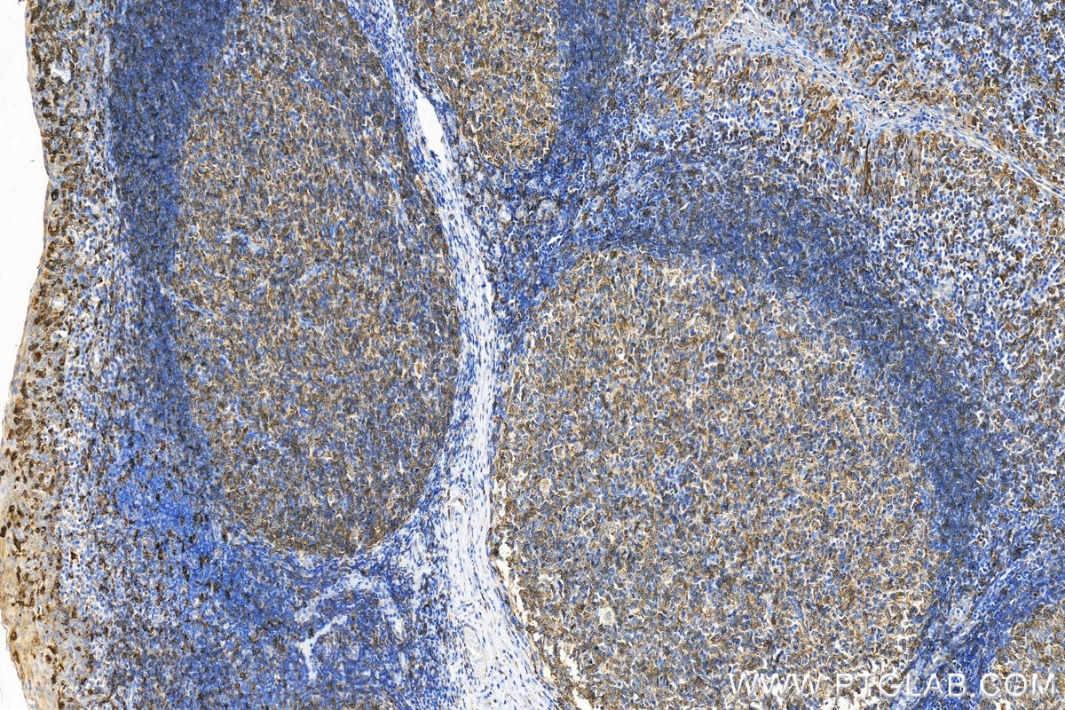 Immunohistochemistry (IHC) staining of human tonsillitis tissue using HLA-DRB5 Polyclonal antibody (21702-1-AP)