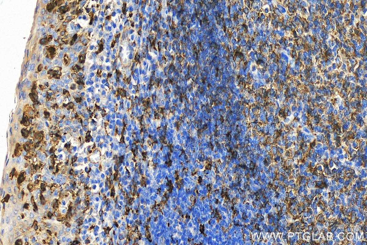 Immunohistochemistry (IHC) staining of human tonsillitis tissue using HLA-DRB5 Polyclonal antibody (21702-1-AP)