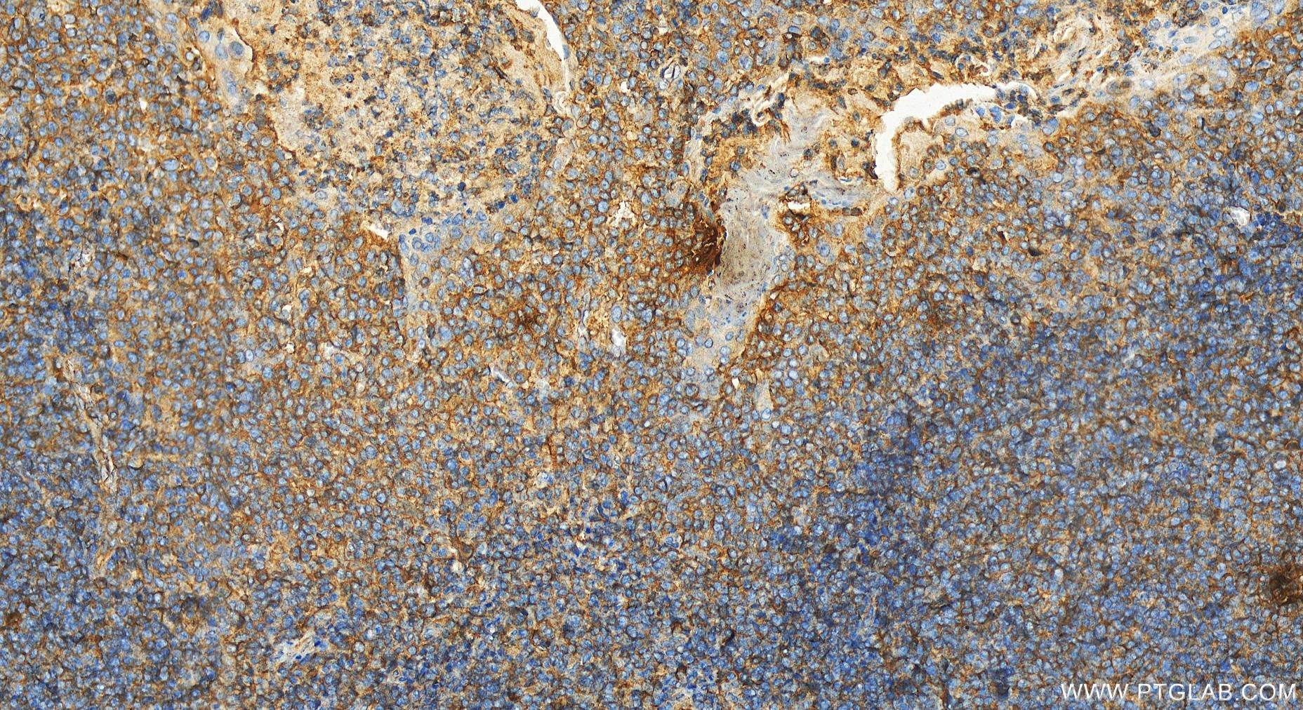 Immunohistochemistry (IHC) staining of human tonsillitis tissue using HLA-F Polyclonal antibody (14670-1-AP)