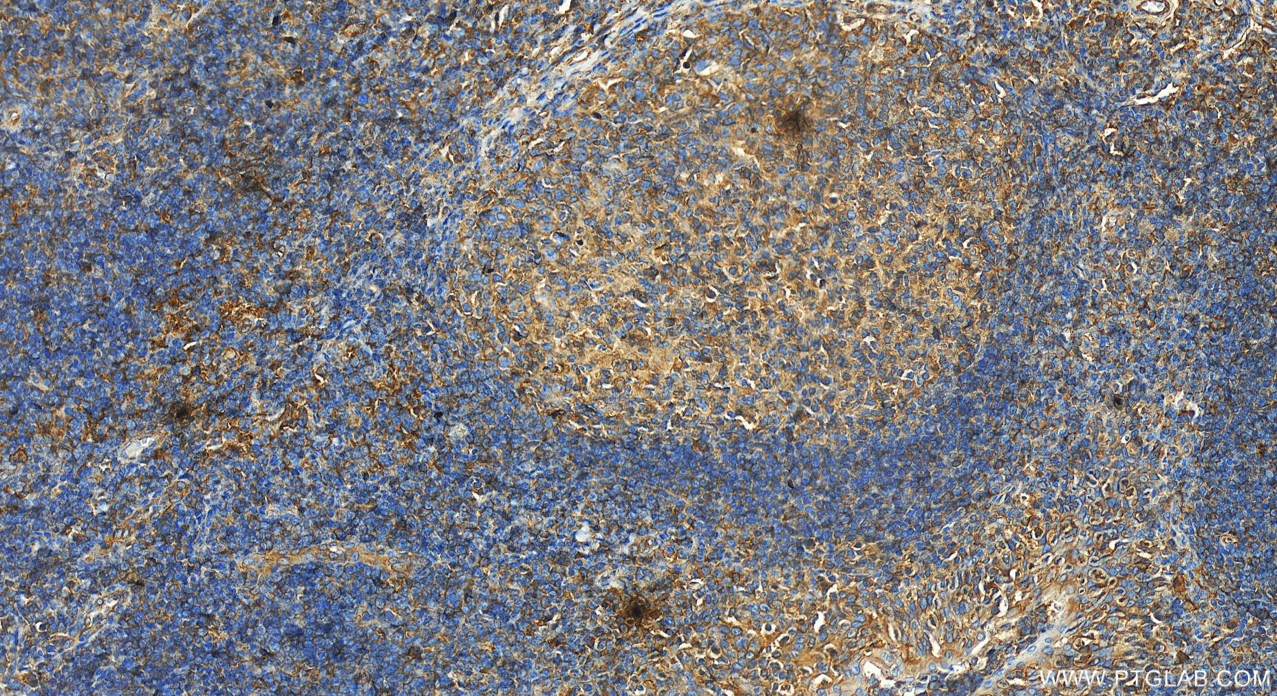 Immunohistochemistry (IHC) staining of human tonsillitis tissue using HLA-F Polyclonal antibody (14670-1-AP)