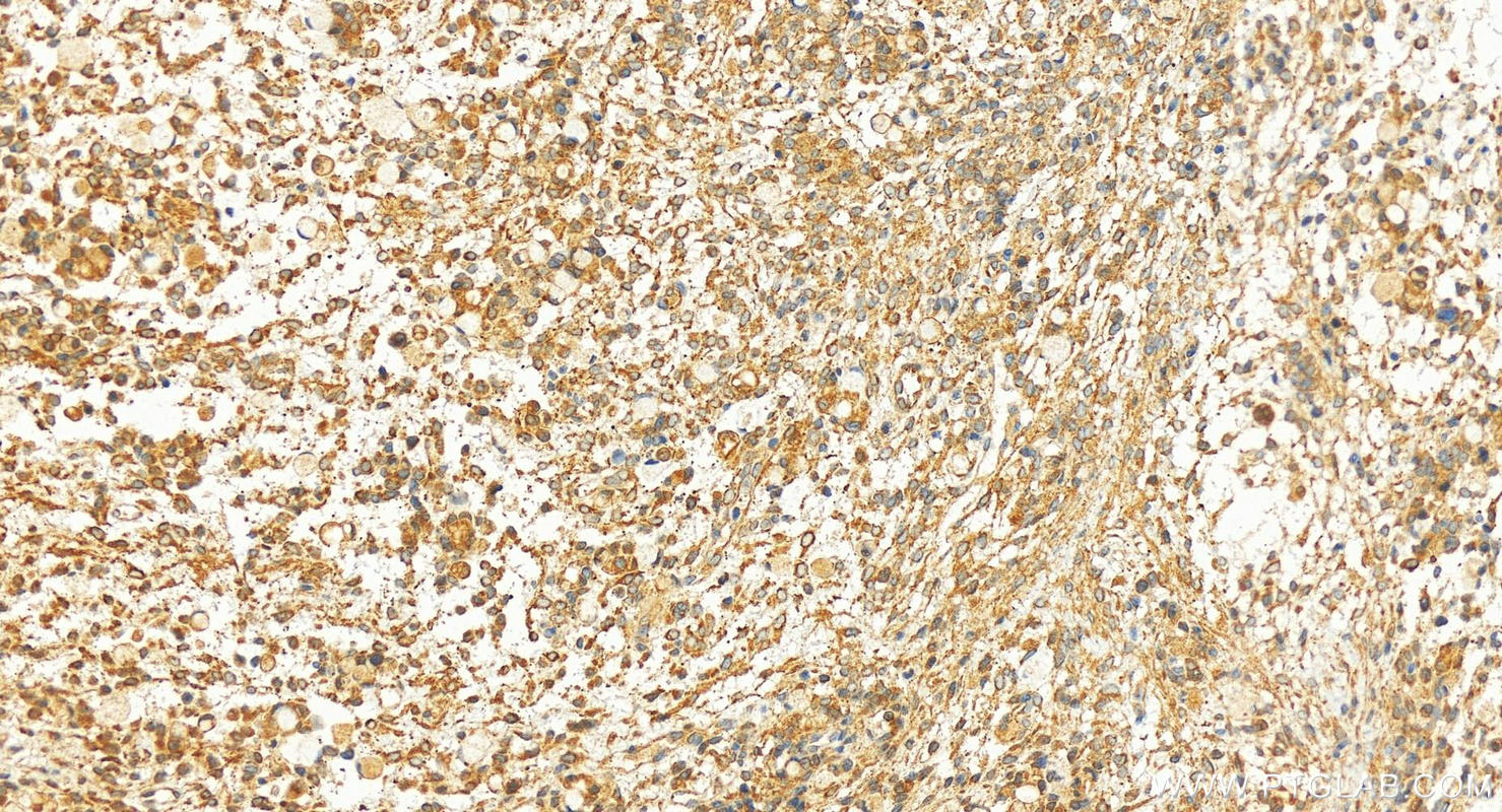 Immunohistochemistry (IHC) staining of human ovary cancer tissue using HLCS Polyclonal antibody (14046-1-AP)