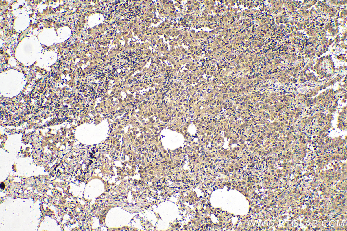 Immunohistochemistry (IHC) staining of human lung cancer tissue using HMGB2 Monoclonal antibody (68185-1-Ig)