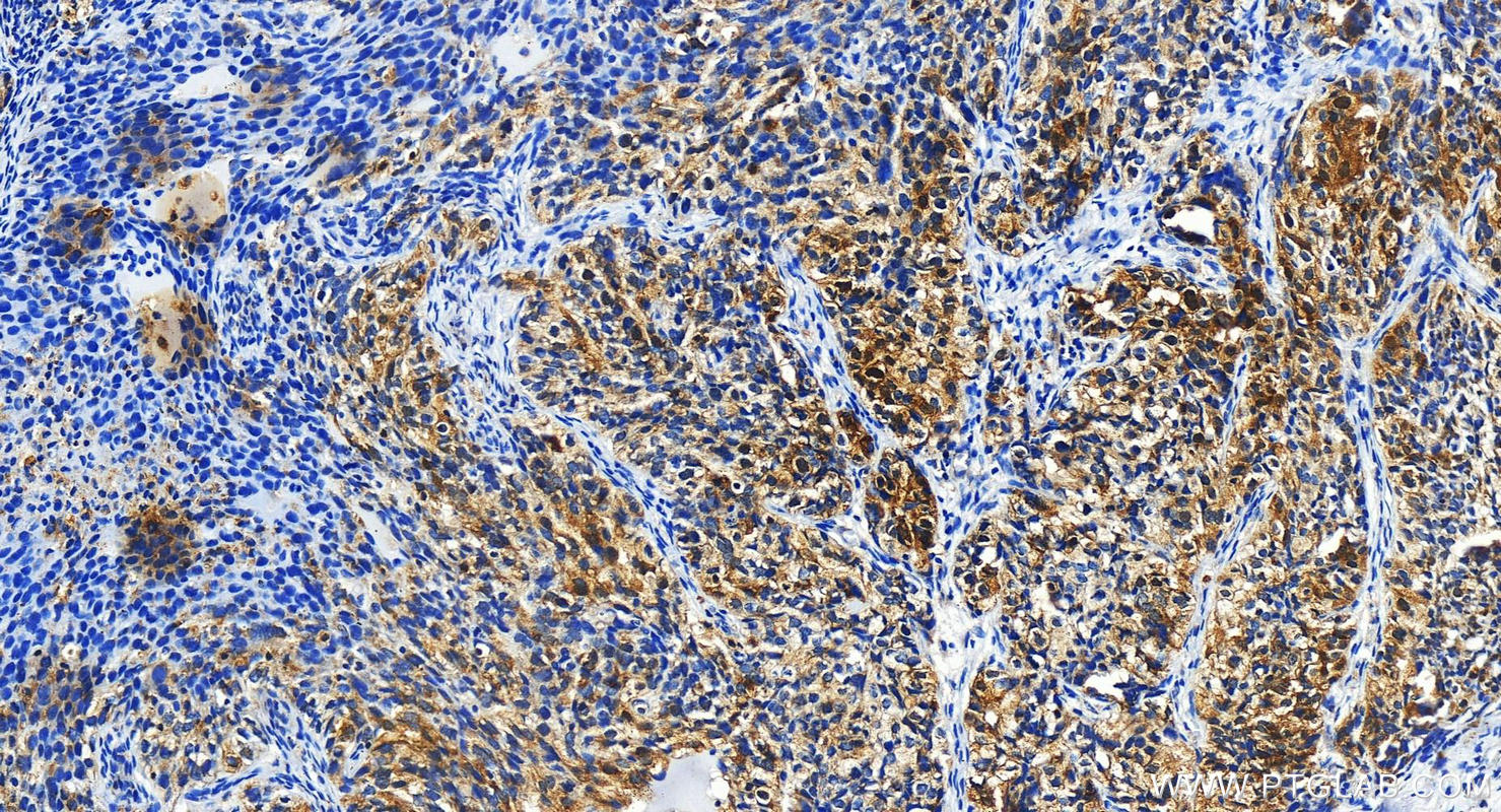 Immunohistochemistry (IHC) staining of human ovary cancer tissue using HMGCS1 Polyclonal antibody (17643-1-AP)