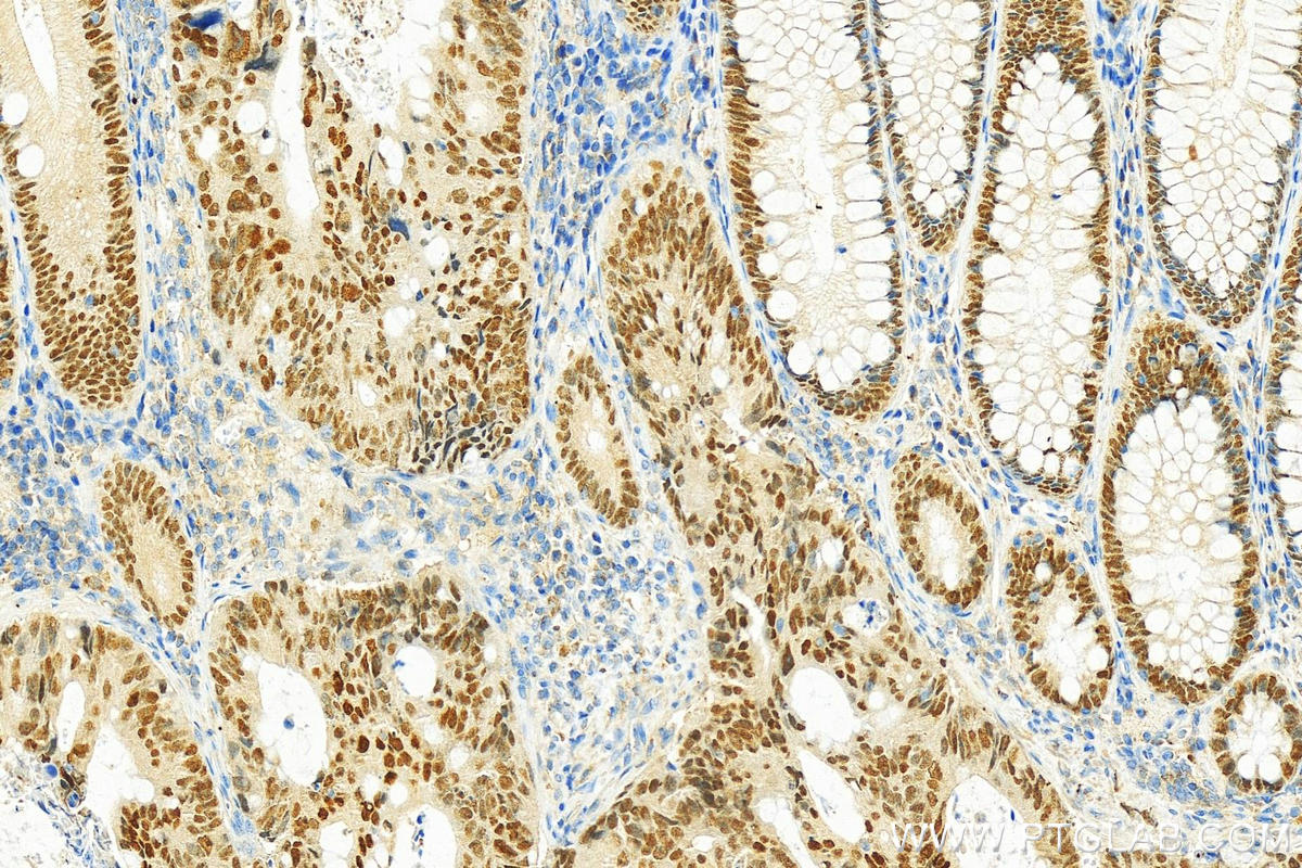 Immunohistochemistry (IHC) staining of human colon cancer tissue using HNF4A Polyclonal antibody (26245-1-AP)