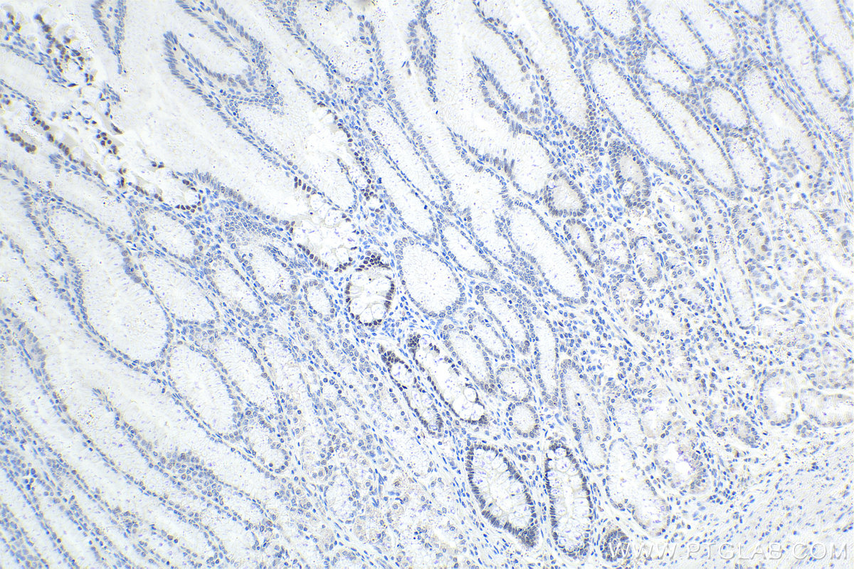 Immunohistochemistry (IHC) staining of human stomach cancer tissue using HNF4G Polyclonal antibody (25801-1-AP)