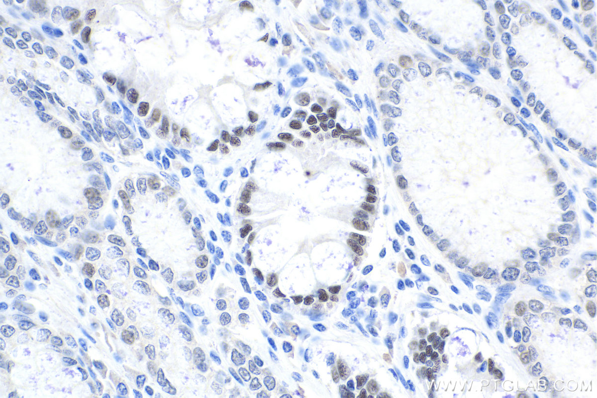 Immunohistochemistry (IHC) staining of human stomach cancer tissue using HNF4G Polyclonal antibody (25801-1-AP)