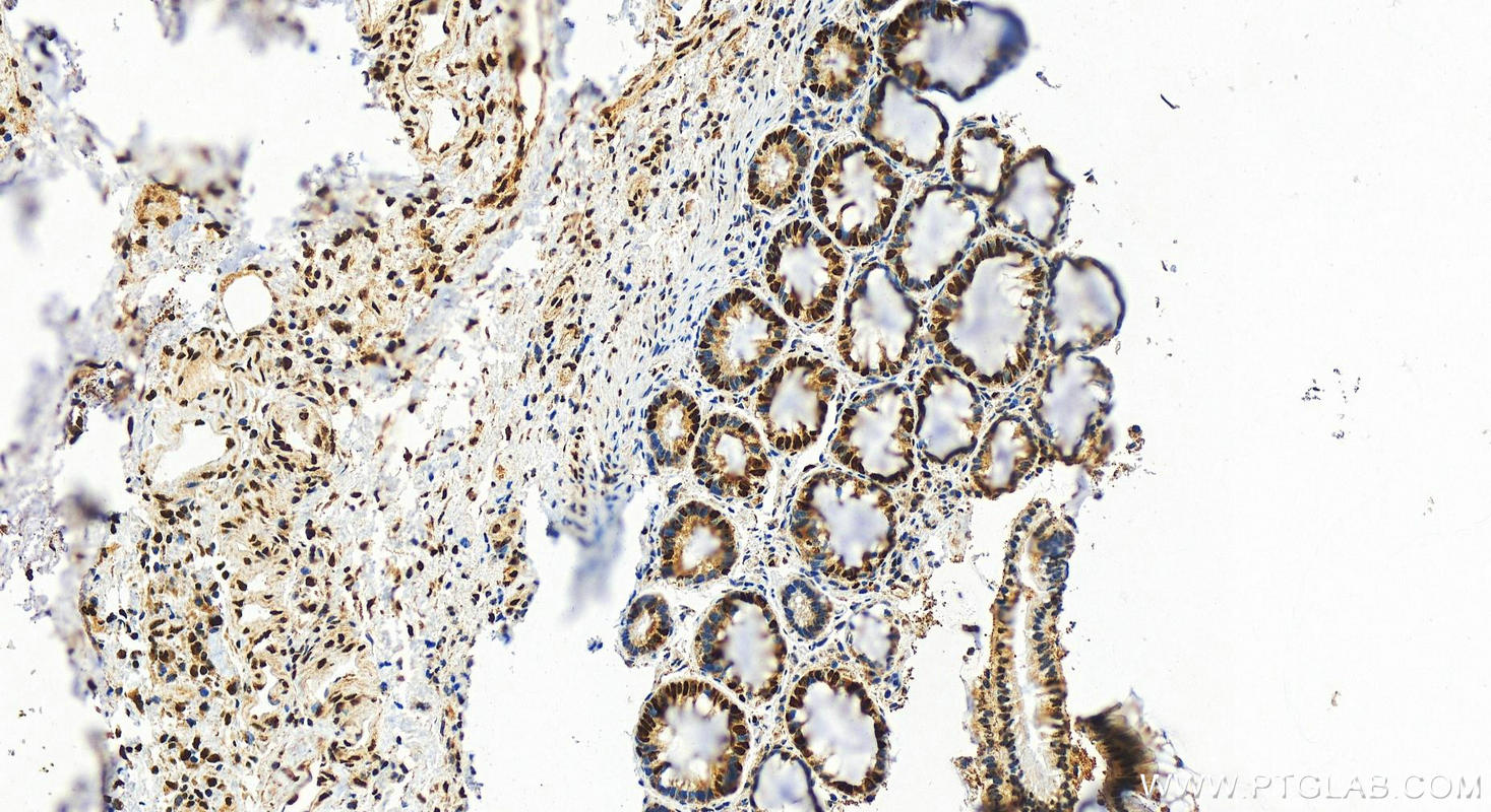 Immunohistochemistry (IHC) staining of human colon cancer tissue using HNRNPL Polyclonal antibody (18354-1-AP)