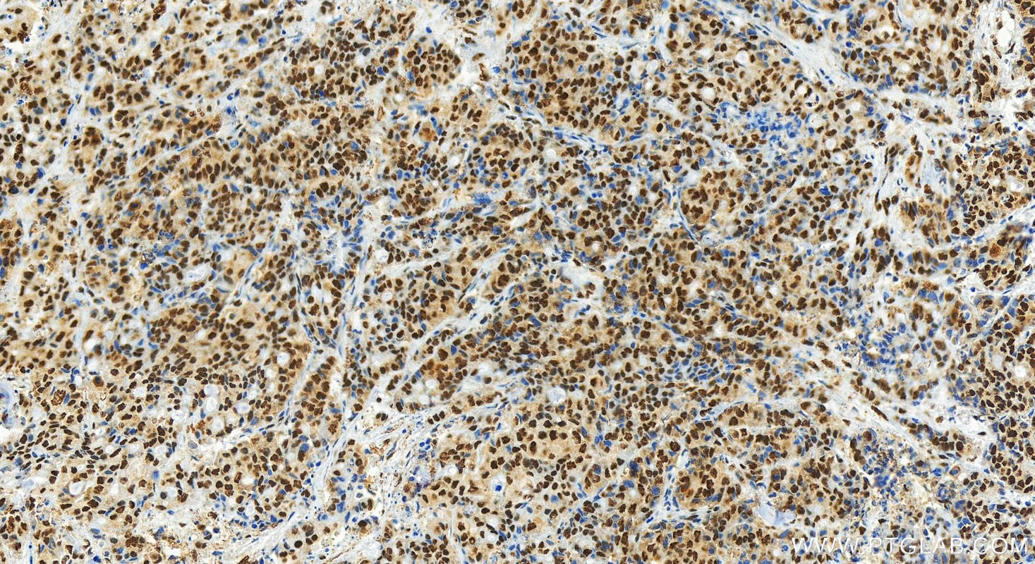 Immunohistochemistry (IHC) staining of human colon cancer tissue using HNRNPL Polyclonal antibody (18354-1-AP)