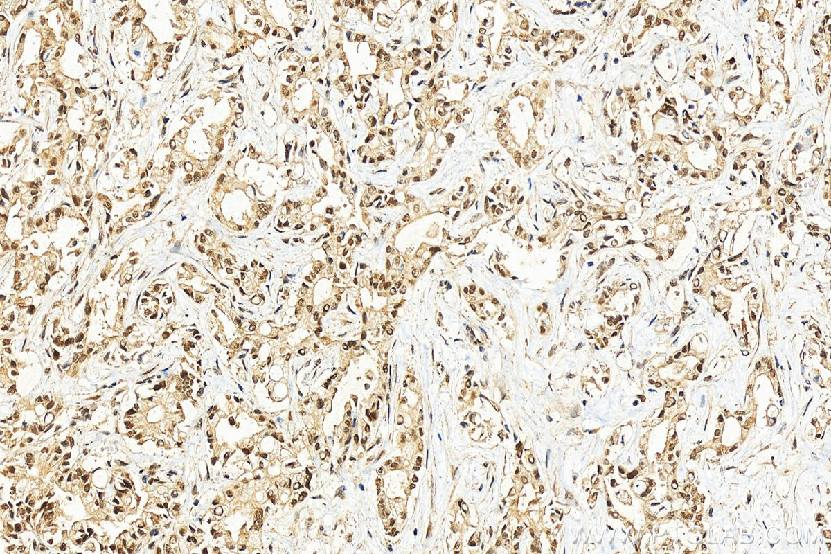 Immunohistochemistry (IHC) staining of human intrahepatic cholangiocarcinoma tissue using HNRPDL Polyclonal antibody (10660-2-AP)