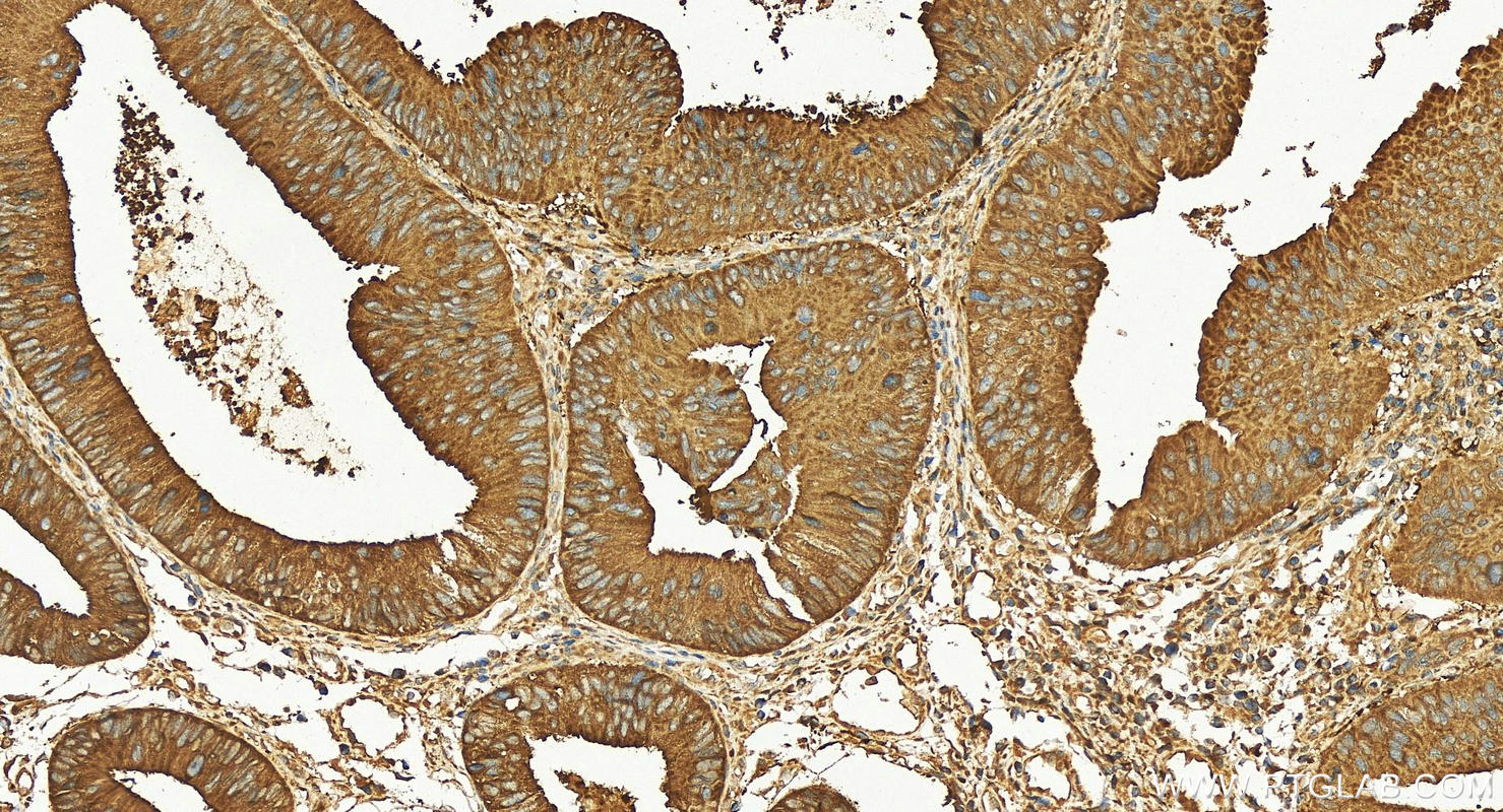 Immunohistochemistry (IHC) staining of human colon cancer tissue using HOOK1 Polyclonal antibody (10871-1-AP)