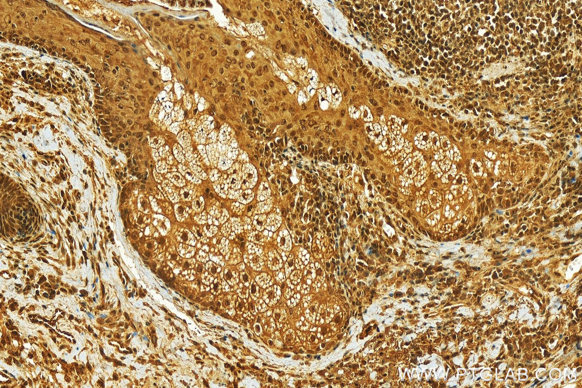 Immunohistochemistry (IHC) staining of human skin cancer tissue using HP1BP3 Polyclonal antibody (24556-1-AP)