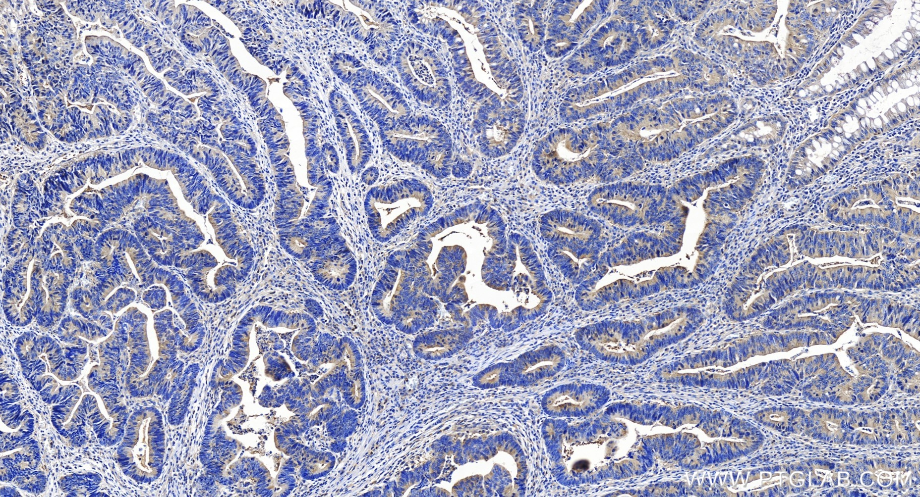 Immunohistochemistry (IHC) staining of human colon cancer tissue using HPRT Recombinant antibody (86049-1-RR)