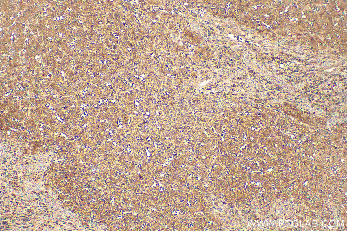 Immunohistochemistry (IHC) staining of human liver cancer tissue using HPRT Polyclonal antibody (15059-1-AP)