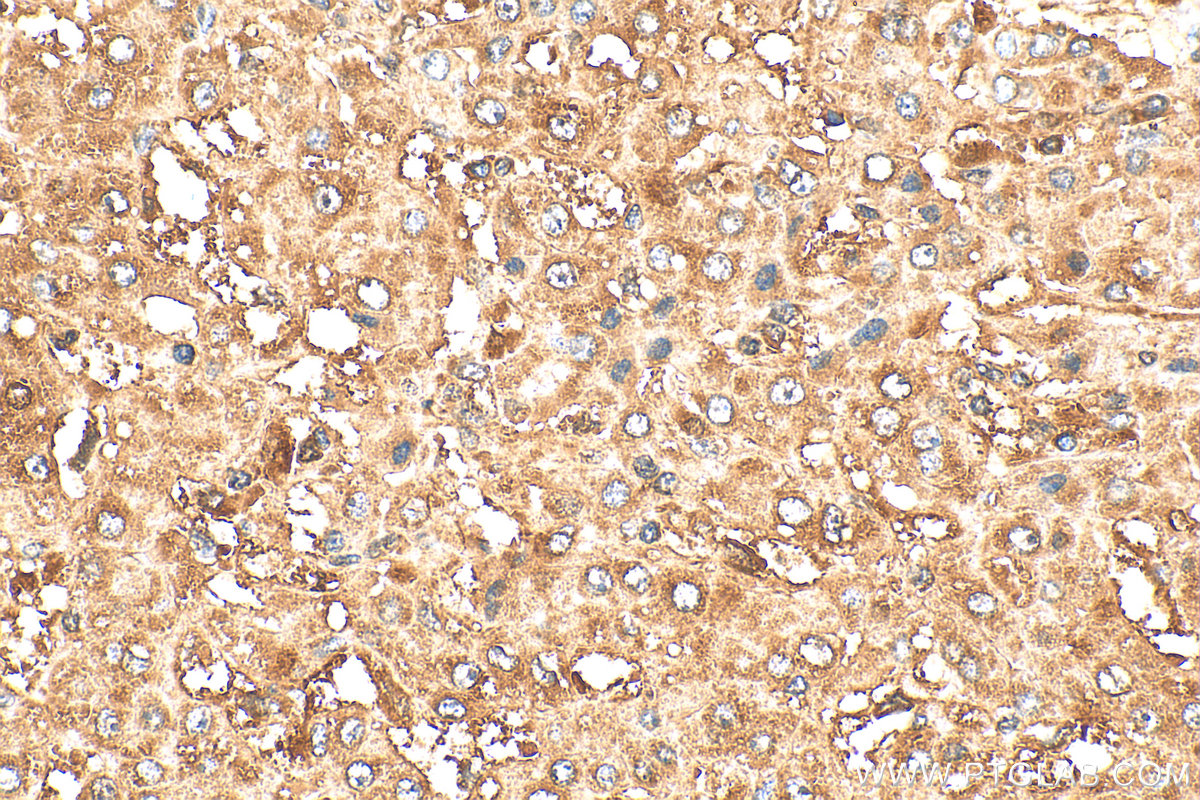 Immunohistochemistry (IHC) staining of human liver cancer tissue using HPRT Polyclonal antibody (15059-1-AP)