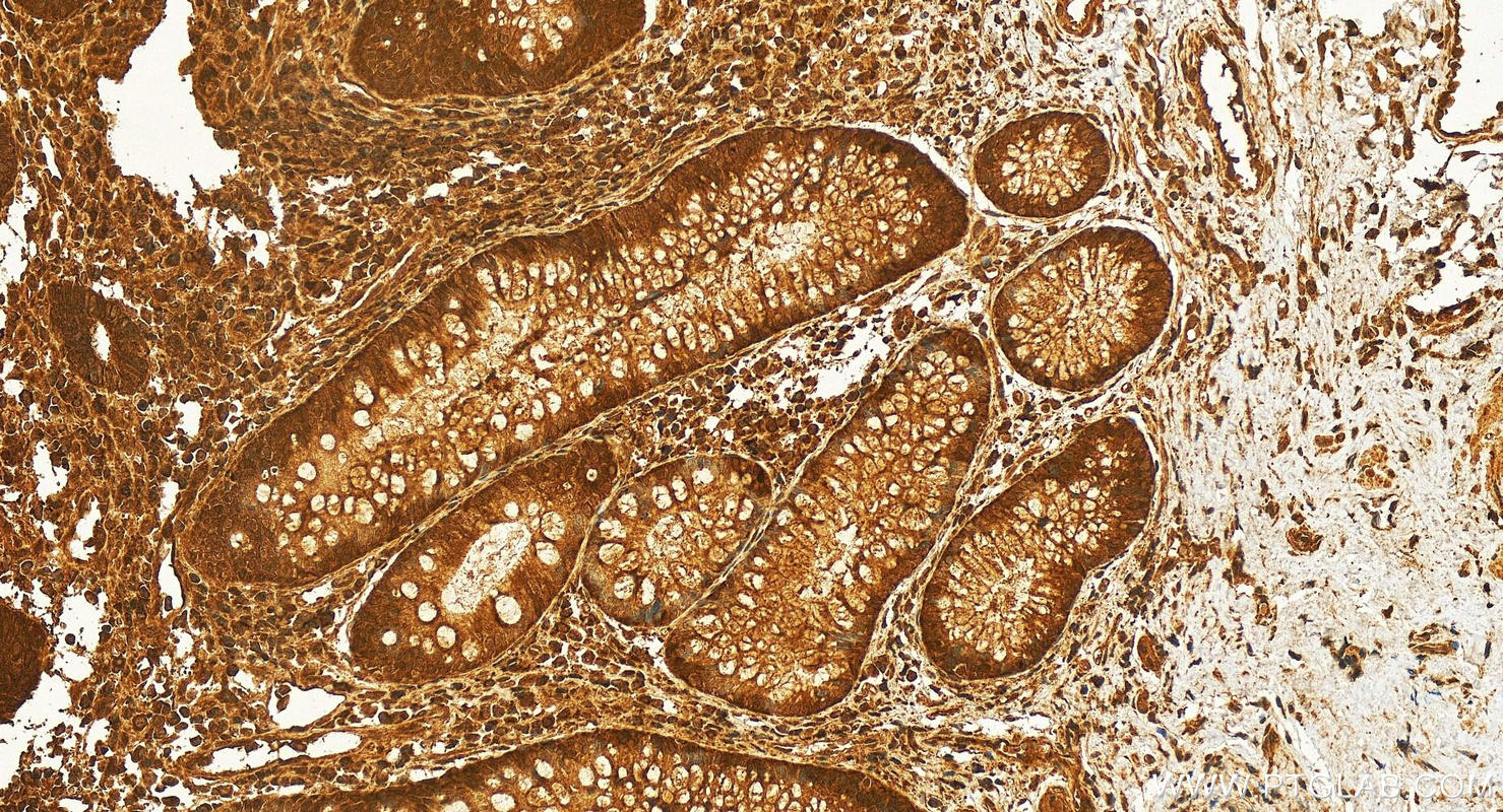 Immunohistochemistry (IHC) staining of human colon cancer tissue using HRAS Polyclonal antibody (18295-1-AP)