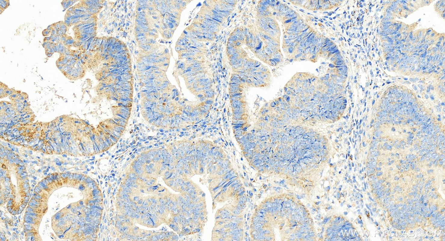 Immunohistochemistry (IHC) staining of human colon cancer tissue using HSCB Polyclonal antibody (15132-1-AP)