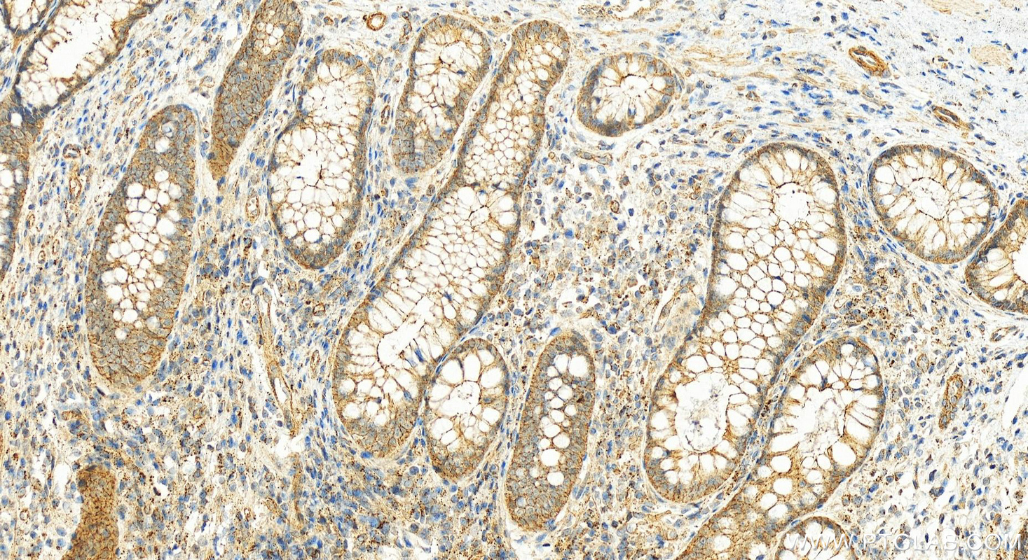 Immunohistochemistry (IHC) staining of human colon cancer tissue using HSD17B1 Polyclonal antibody (25334-1-AP)