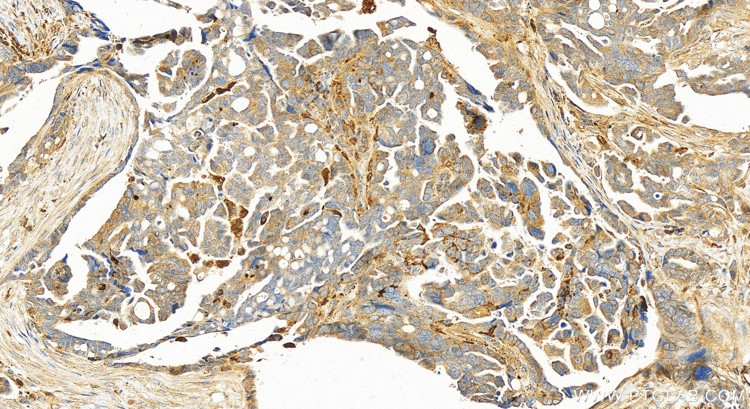 Immunohistochemistry (IHC) staining of human ovary cancer tissue using HSD17B11 Polyclonal antibody (16303-1-AP)