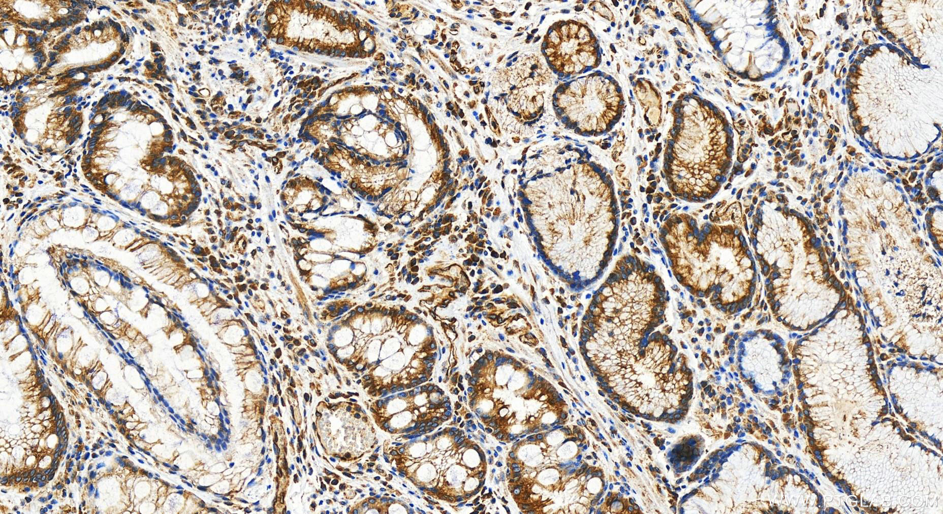 Immunohistochemistry (IHC) staining of human stomach cancer tissue using HSD17B12 Polyclonal antibody (31463-1-AP)