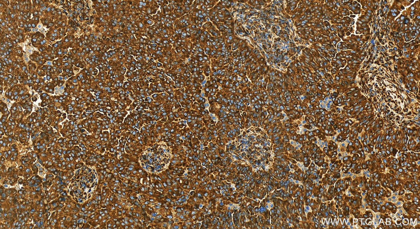 Immunohistochemistry (IHC) staining of human ovarian  cancer using HSP47/SERPINH1 Recombinant antibody (83689-3-RR)