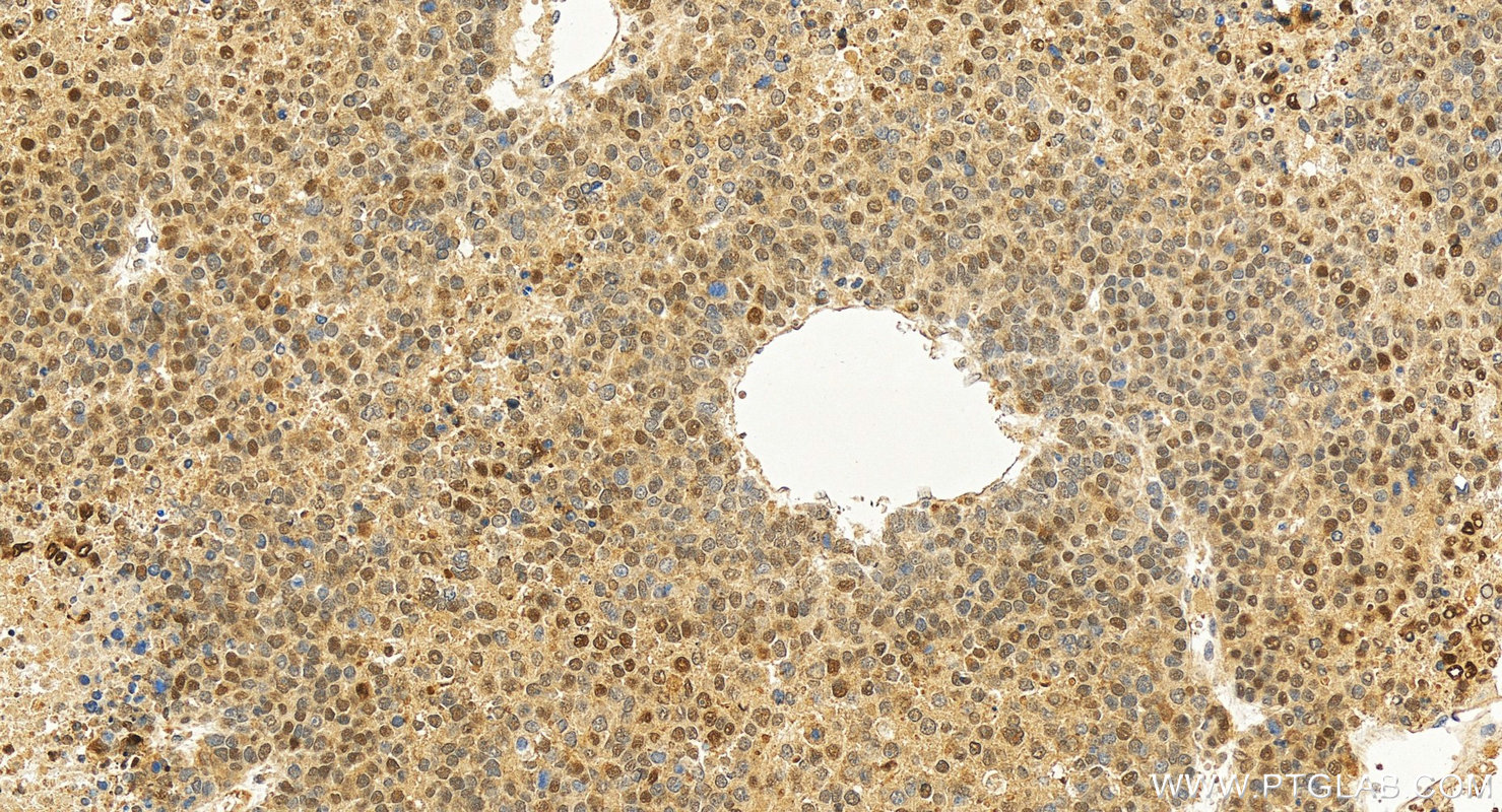 Immunohistochemistry (IHC) staining of human hepatocellular carcinoma using HSP70 Monoclonal antibody (66183-1-Ig)