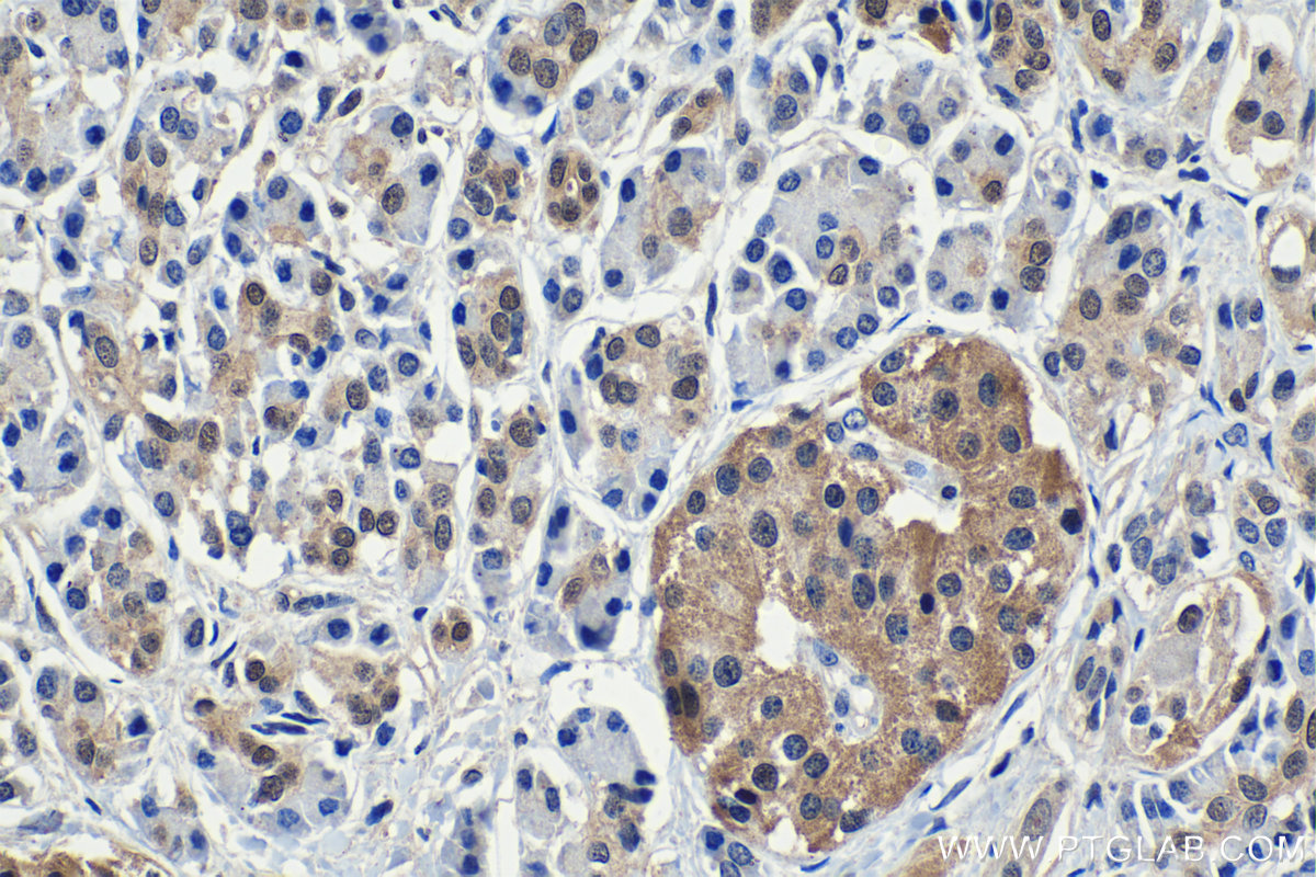 Immunohistochemistry (IHC) staining of human pancreas cancer tissue using HSP70 Monoclonal antibody (66183-1-Ig)