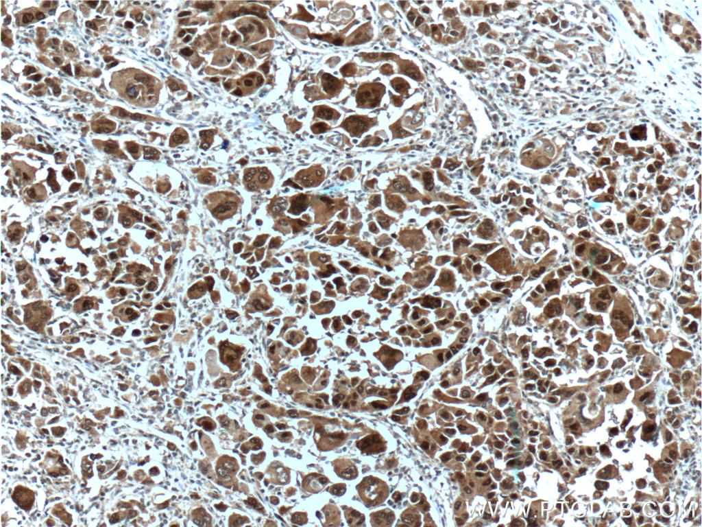 Immunohistochemistry (IHC) staining of human liver cancer tissue using HSP70 Monoclonal antibody (66183-1-Ig)