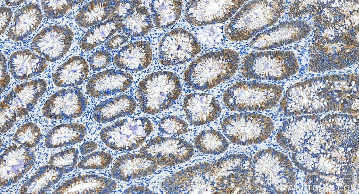 Immunohistochemistry (IHC) staining of human colon cancer tissue using HSP70 Recombinant antibody (80735-1-RR)