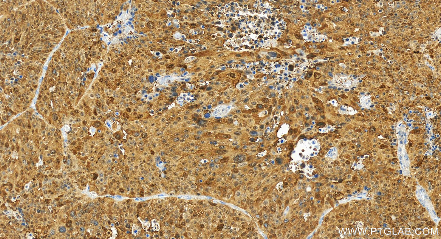 Immunohistochemistry (IHC) staining of human lung squamous cell carcinoma tissue using HSP70 Recombinant antibody (80735-1-RR)