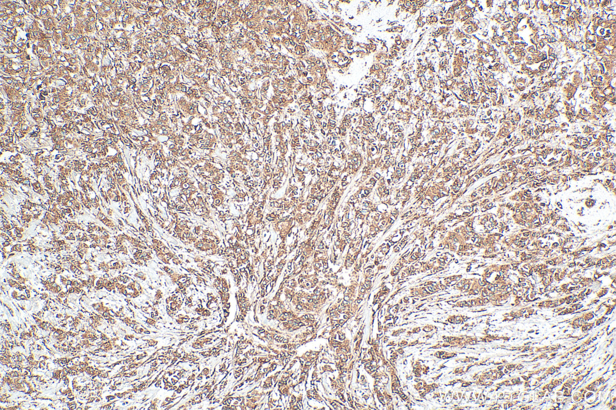 Immunohistochemistry (IHC) staining of human breast cancer tissue using GRP94 Polyclonal antibody (14700-1-AP)