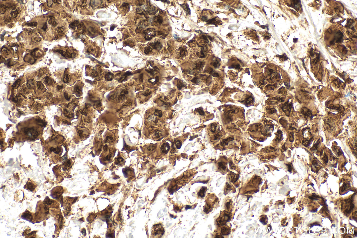Immunohistochemistry (IHC) staining of human breast cancer tissue using HSP70 Polyclonal antibody (10995-1-AP)
