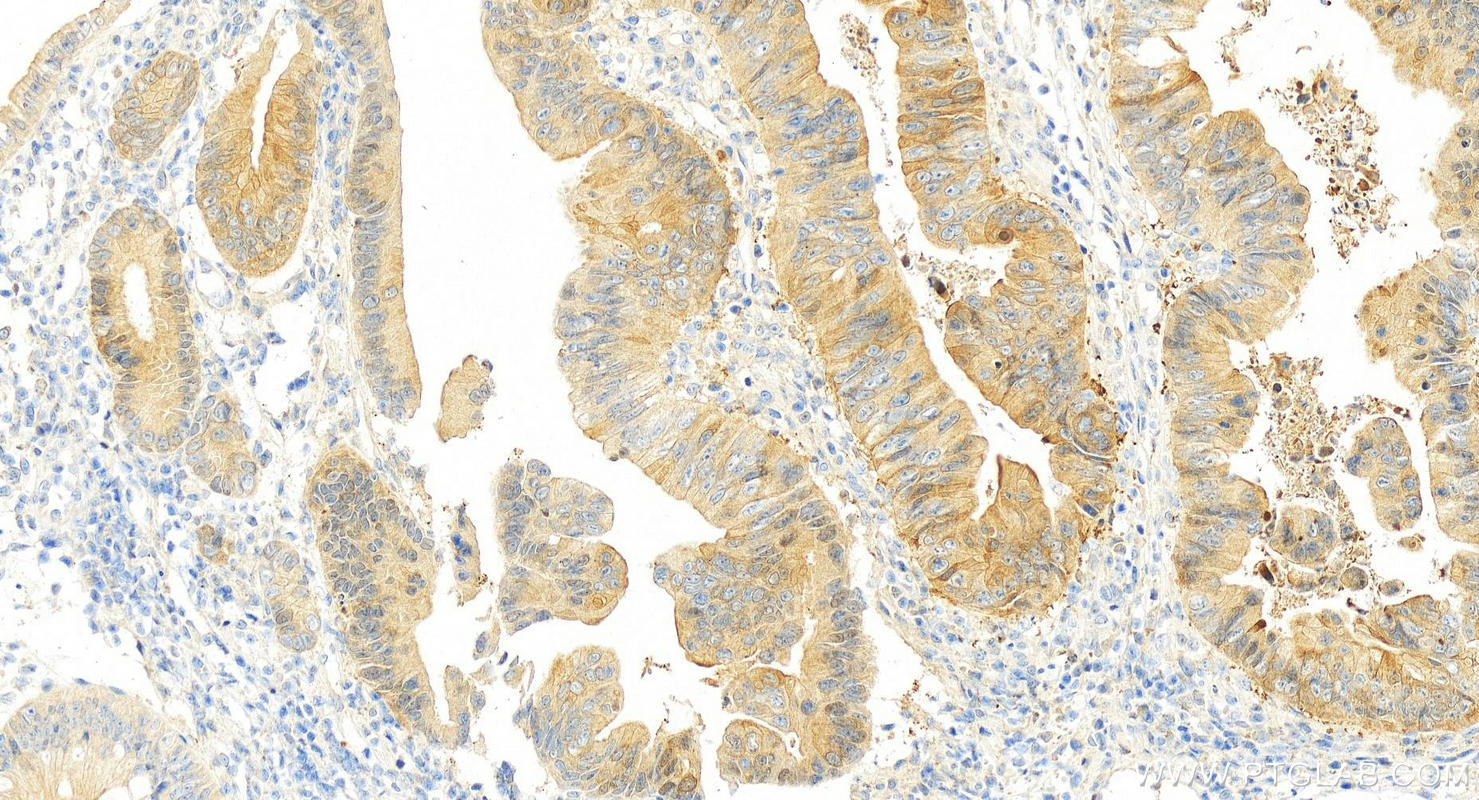 Immunohistochemistry (IHC) staining of human colon cancer tissue using HSPH1 Polyclonal antibody (13383-1-AP)