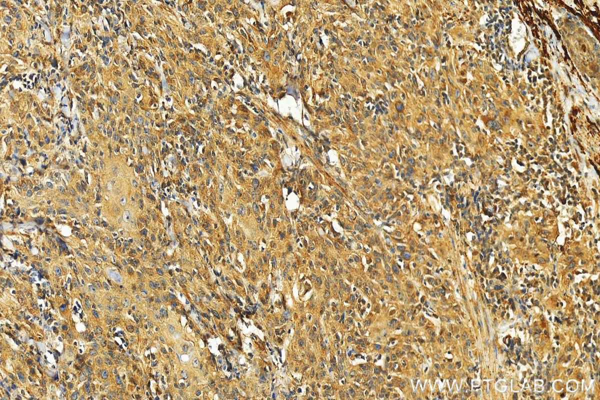 Immunohistochemistry (IHC) staining of human skin cancer tissue using HTRA1 Polyclonal antibody (29618-1-AP)