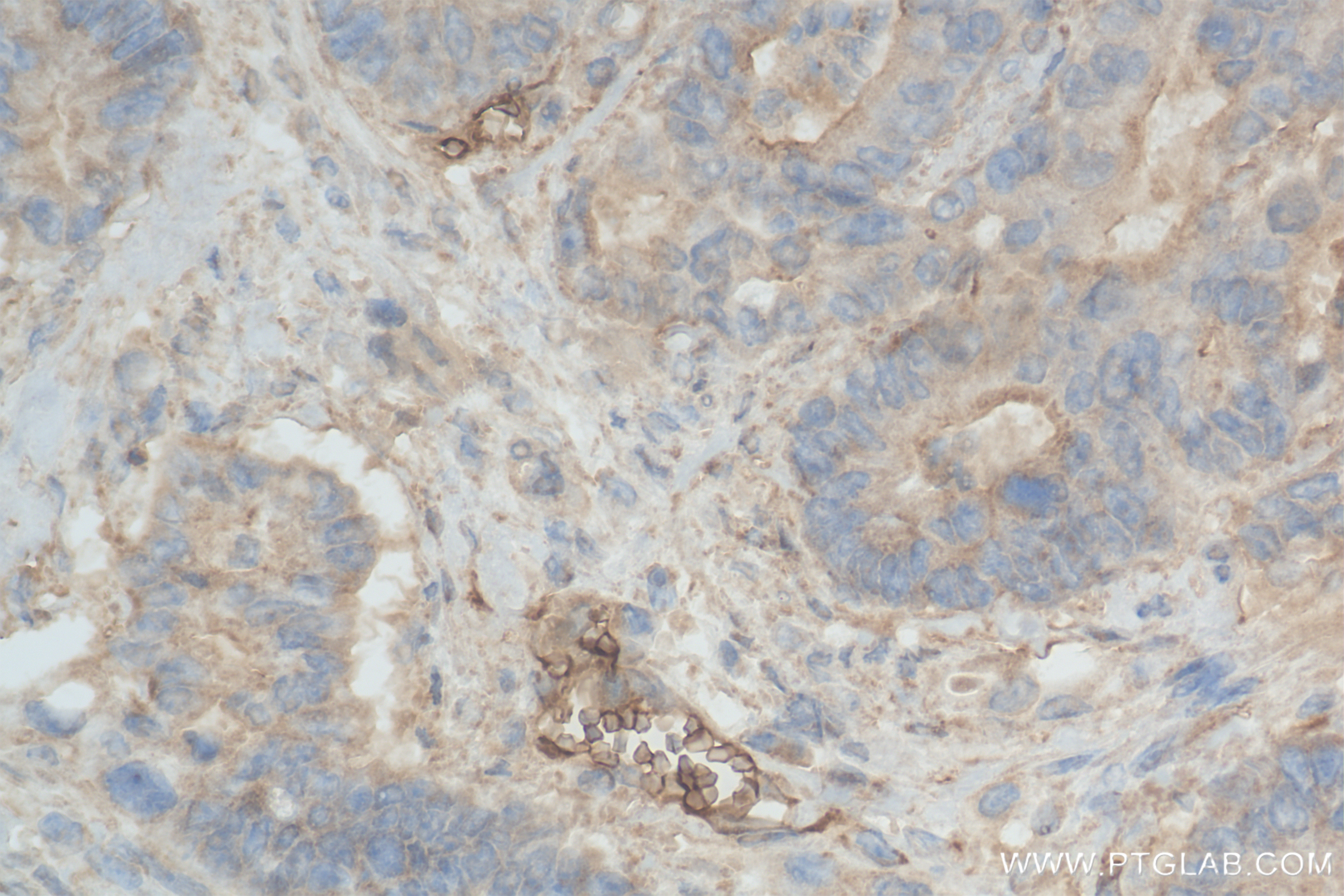 Immunohistochemistry (IHC) staining of human rectal cancer tissue using HUWE1 Recombinant antibody (85177-3-RR)