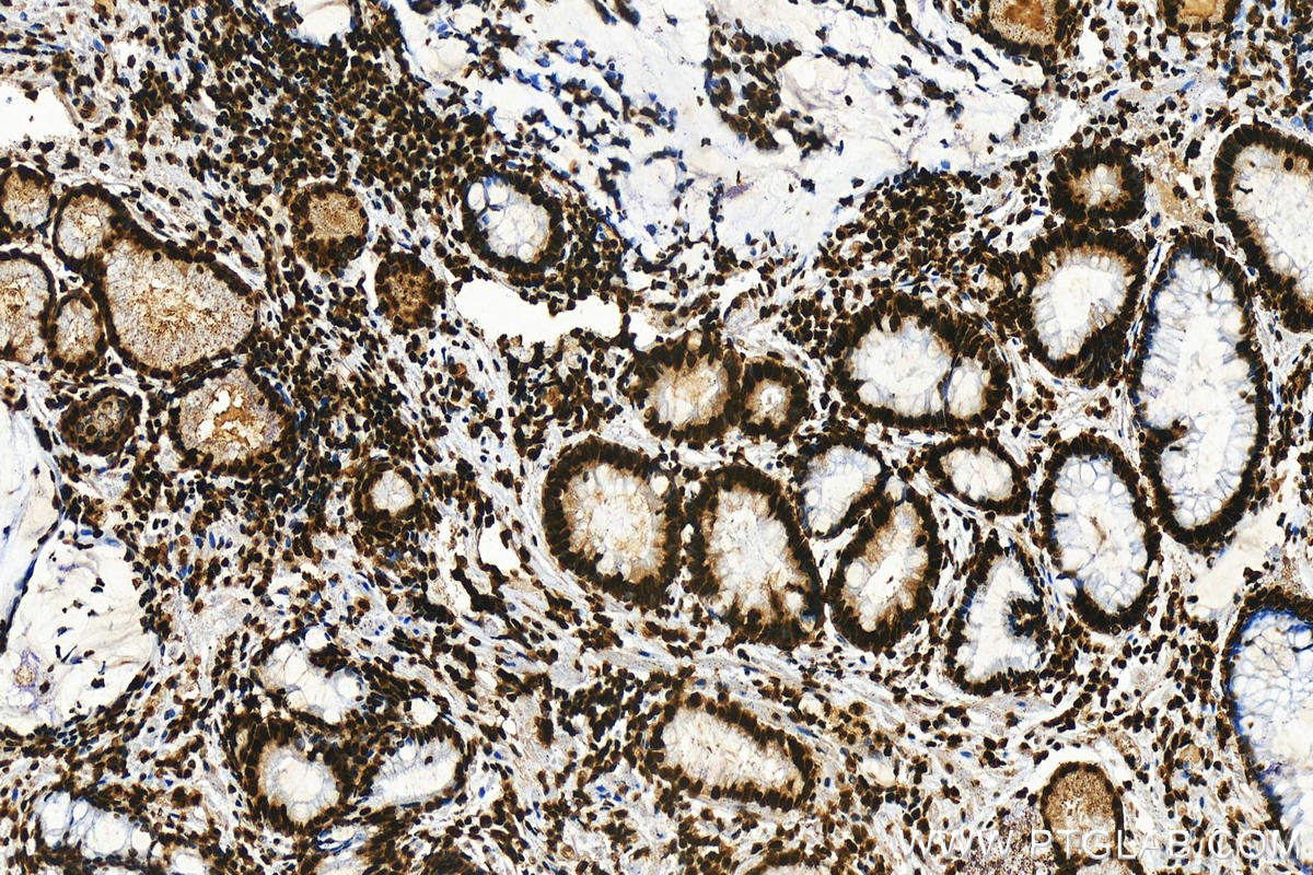 Immunohistochemistry (IHC) staining of human stomach cancer tissue using Histone H2A.X Monoclonal antibody (68888-1-Ig)