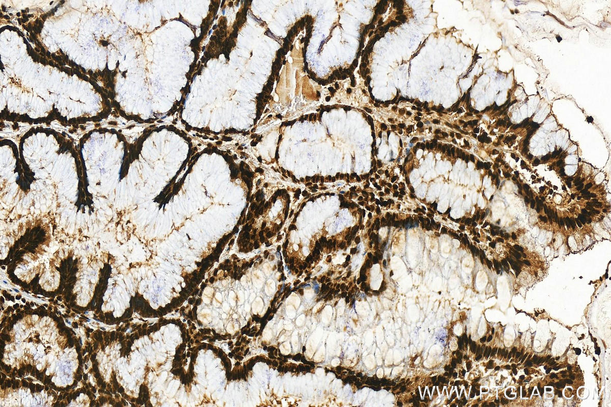 Immunohistochemistry (IHC) staining of human  stomach cancer using Histone H2A.X Monoclonal antibody (68888-1-Ig)