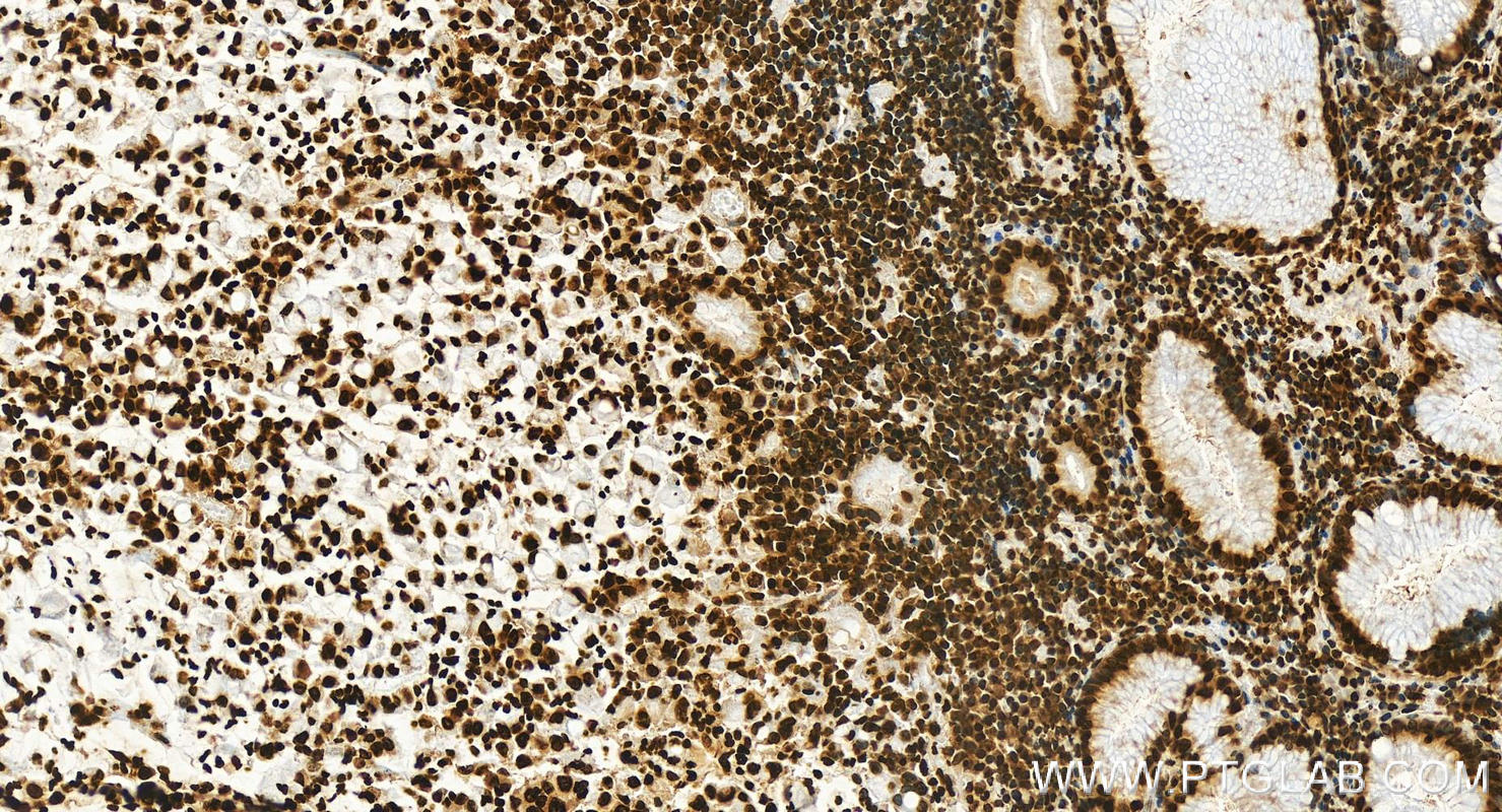 Immunohistochemistry (IHC) staining of human stomach cancer tissue using Histone H2A.X Monoclonal antibody (68888-1-Ig)