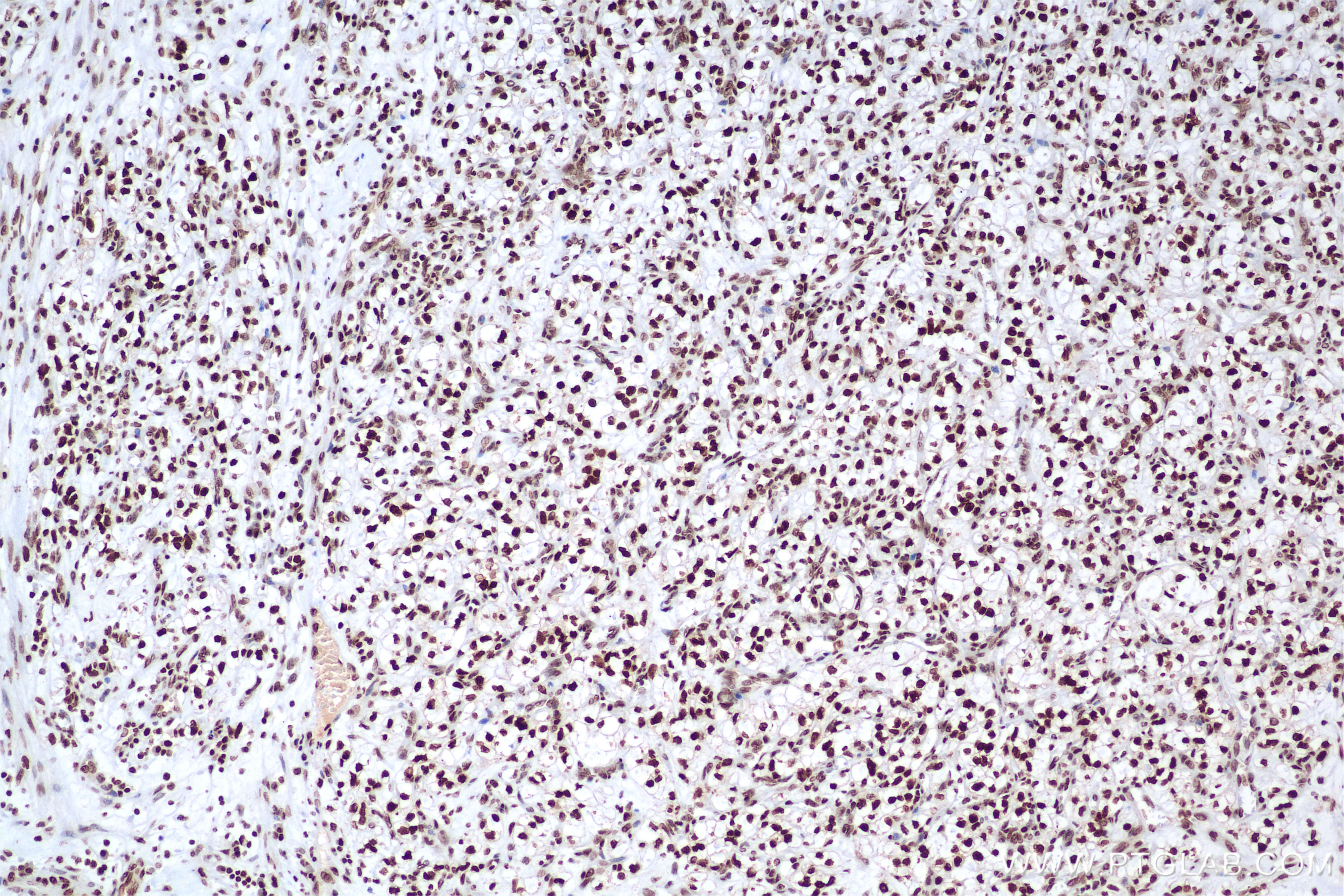 Immunohistochemistry (IHC) staining of human kidney(renal cell) Cancer using Histone H2A.X Recombinant antibody (83307-3-RR)