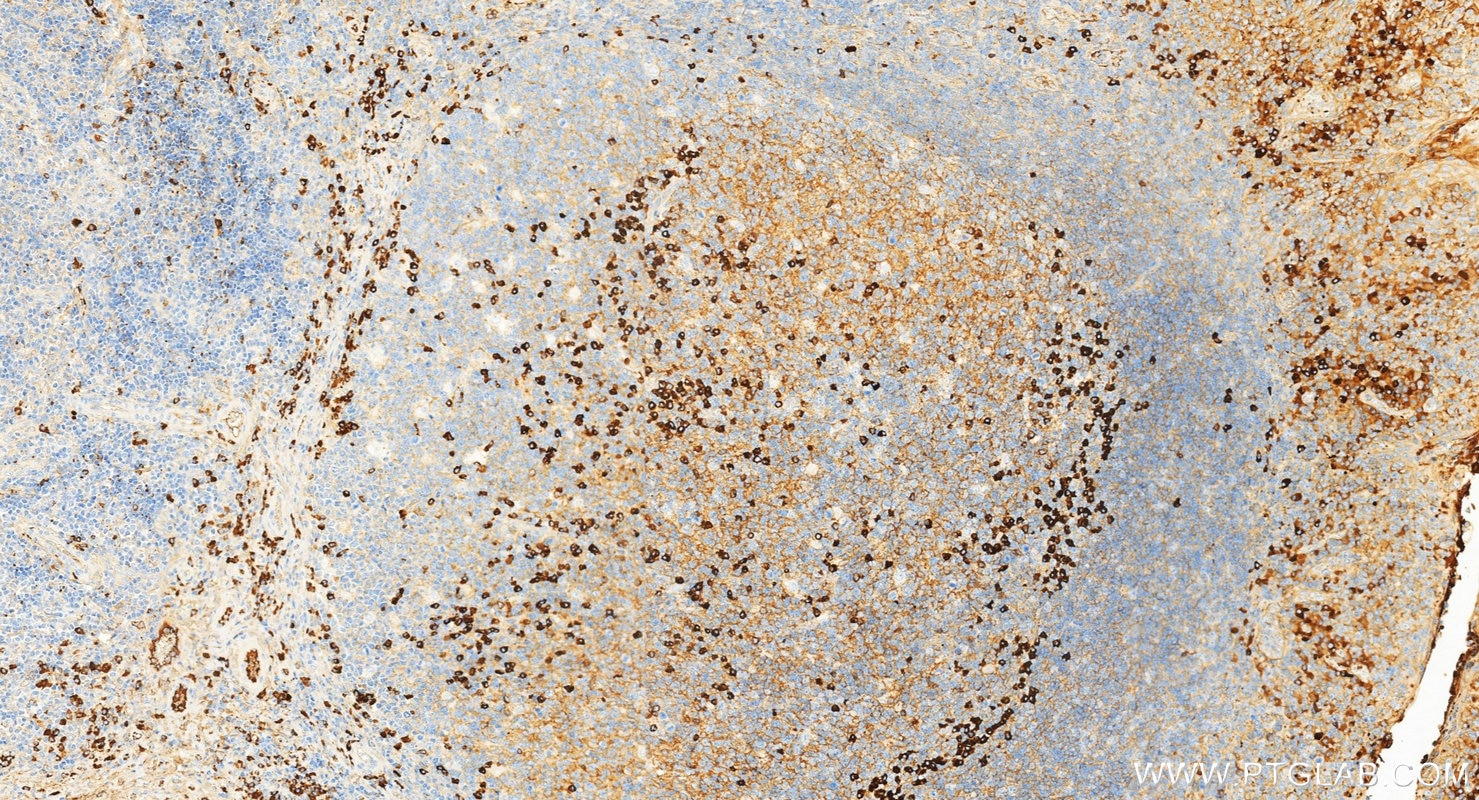 Immunohistochemistry (IHC) staining of human tonsillitis tissue using Rabbit Anti-Human IgG Polyclonal antibody (10284-1-AP)
