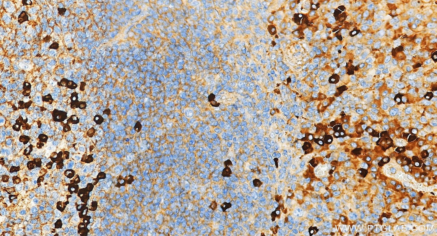 Immunohistochemistry (IHC) staining of human tonsillitis tissue using Rabbit Anti-Human IgG Polyclonal antibody (10284-1-AP)