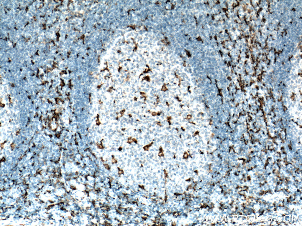 Immunohistochemistry (IHC) staining of human tonsillitis tissue using IBA1 Monoclonal antibody (66827-2-Ig)