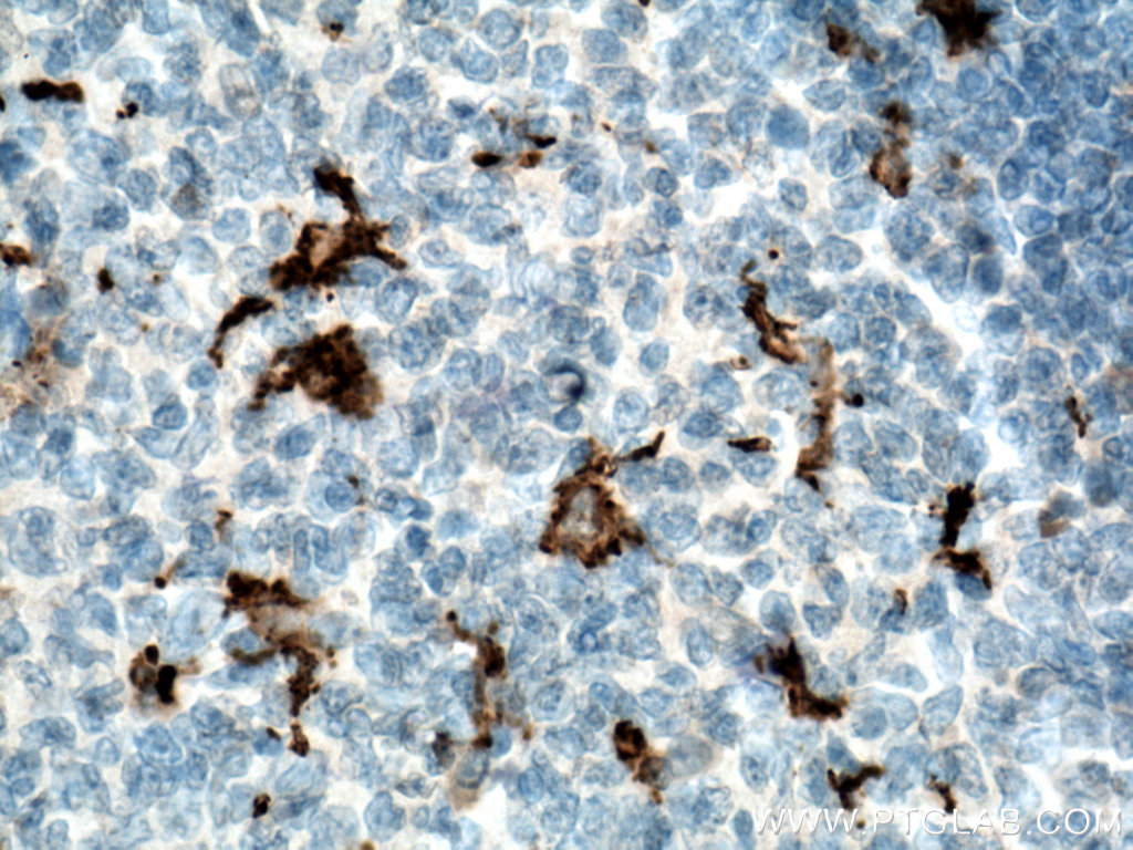 Immunohistochemistry (IHC) staining of human tonsillitis tissue using IBA1 Monoclonal antibody (66827-2-Ig)