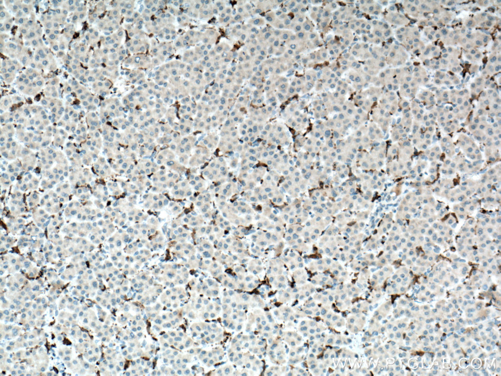 Immunohistochemistry (IHC) staining of human liver cancer tissue using IBA1 Monoclonal antibody (66827-2-Ig)