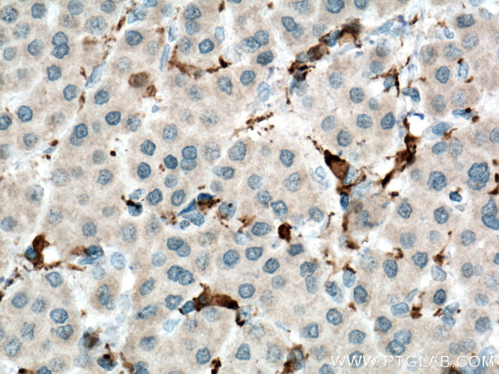 Immunohistochemistry (IHC) staining of human liver cancer tissue using IBA1 Monoclonal antibody (66827-2-Ig)