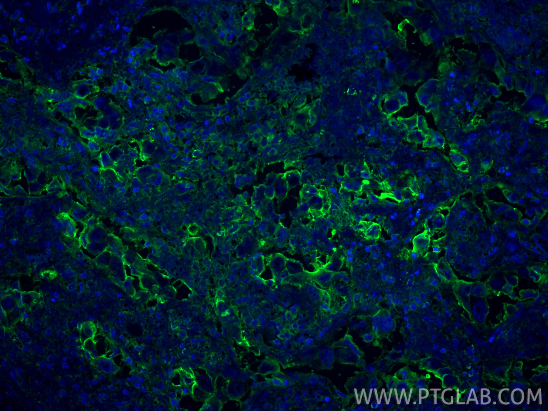 Immunofluorescence (IF) / fluorescent staining of human lung cancer tissue using ICAM-1/CD54 Polyclonal antibody (10831-1-AP)