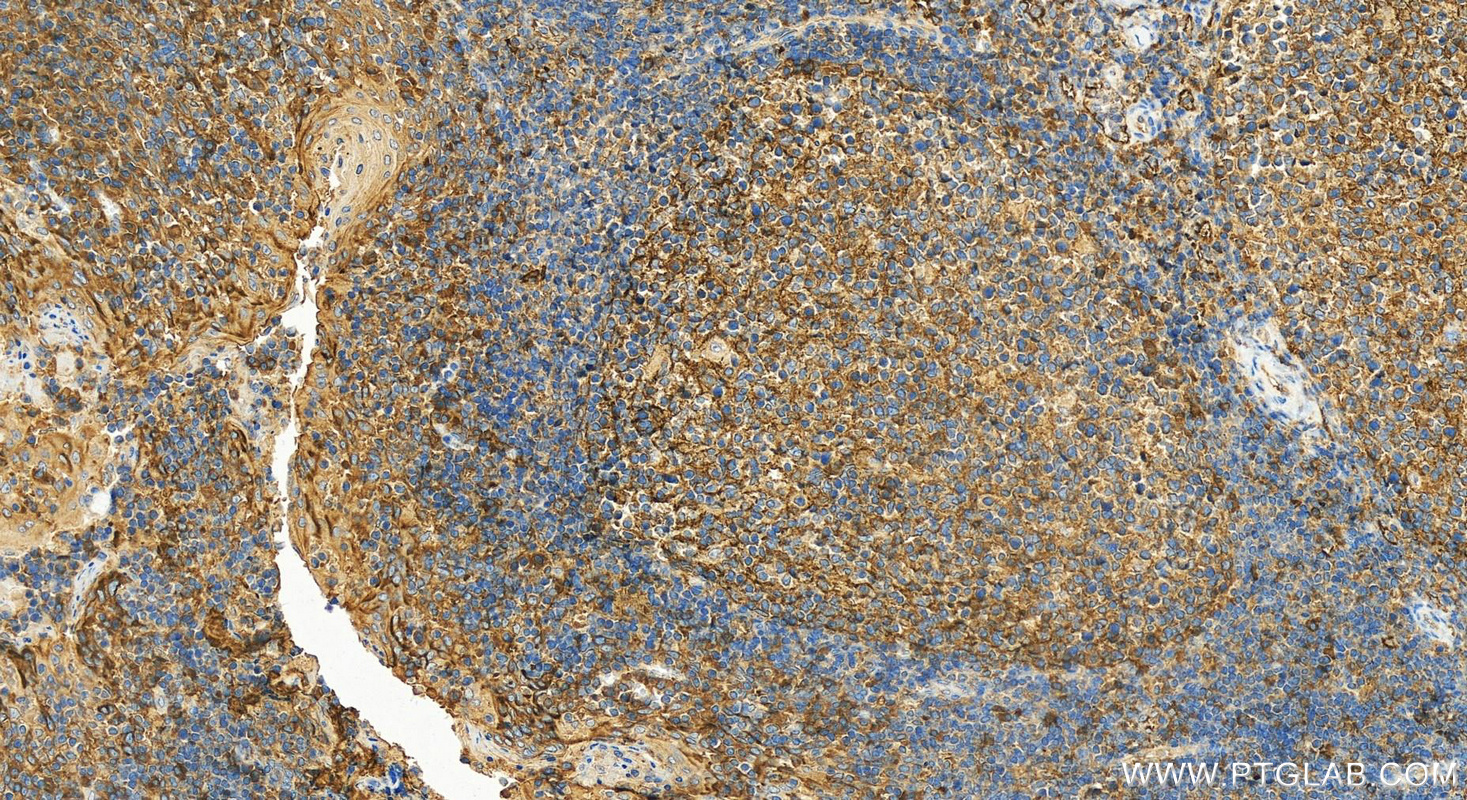 Immunohistochemistry (IHC) staining of human tonsillitis tissue using ICAM-1/CD54 Polyclonal antibody (10831-1-AP)