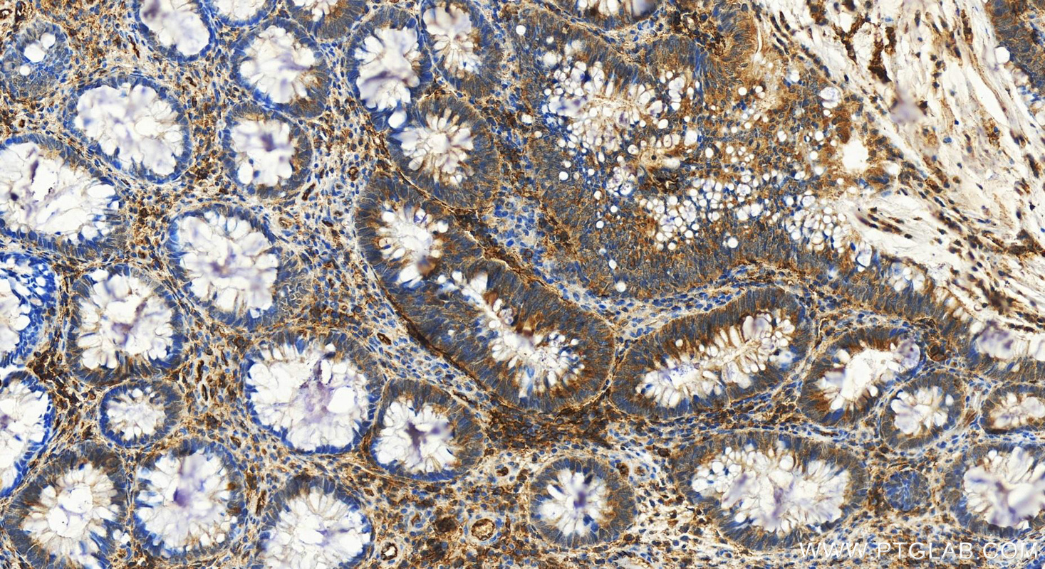 Immunohistochemistry (IHC) staining of human colon cancer tissue using ICAM-1/CD54 Polyclonal antibody (15364-1-AP)