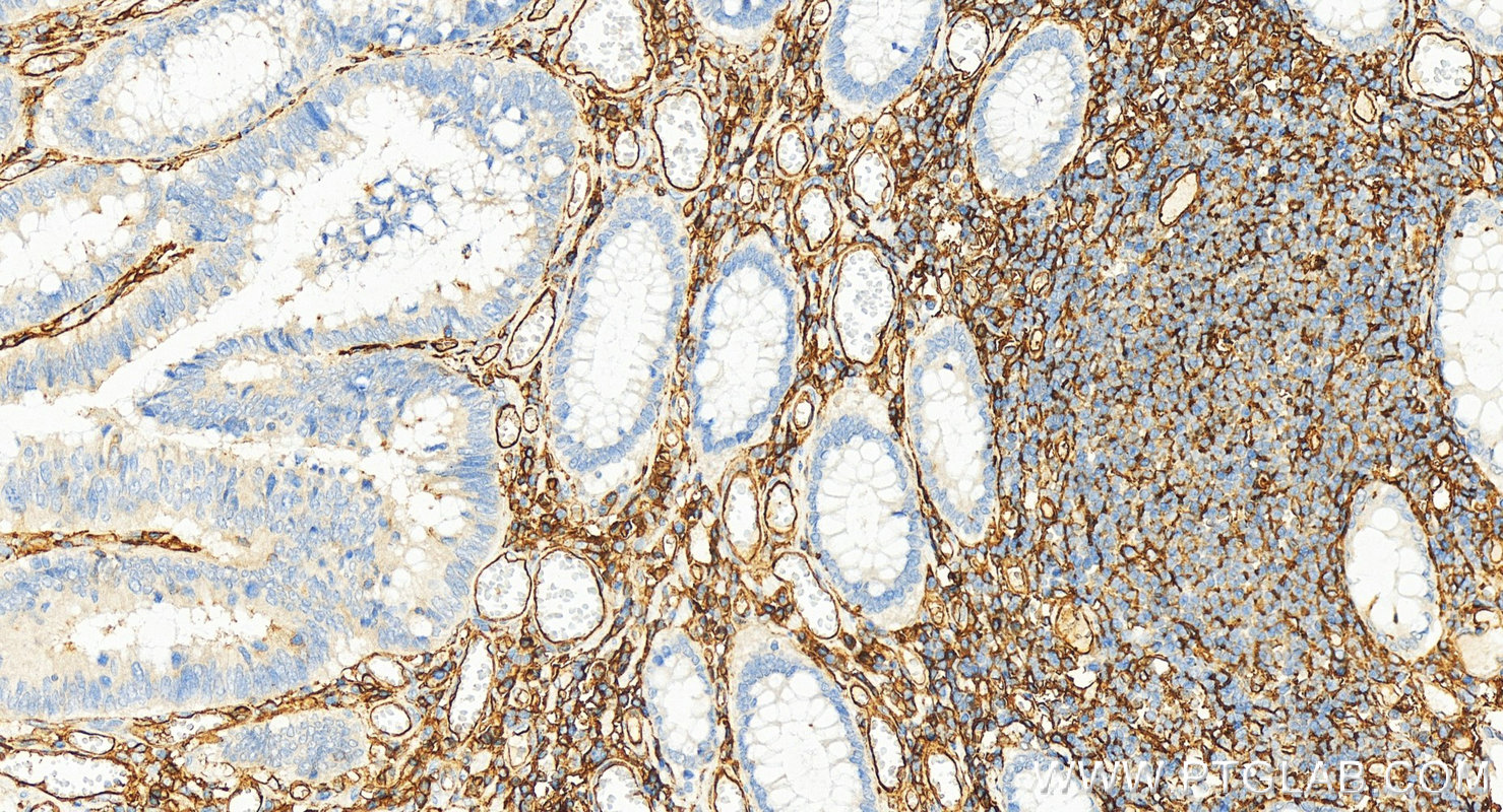 Immunohistochemistry (IHC) staining of human colon cancer tissue using ICAM-1/CD54 Polyclonal antibody (15364-1-AP)
