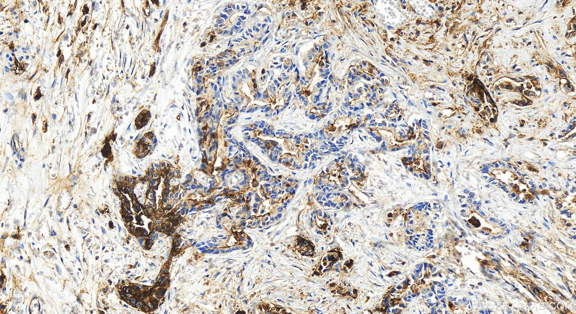 Immunohistochemistry (IHC) staining of human intrahepatic cholangiocarcinoma tissue using ICAM-1/CD54 Polyclonal antibody (30806-1-AP)